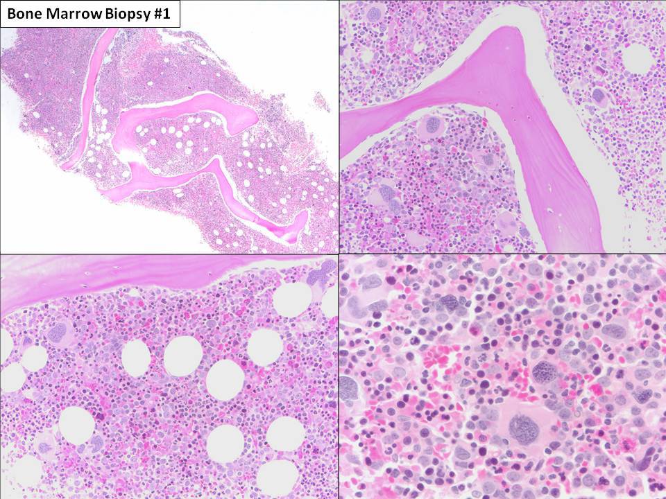 Bone marrow biopsy #1: The marrow is hypercellular (90% cellular). Many dysplastic megakaryocytes are present.